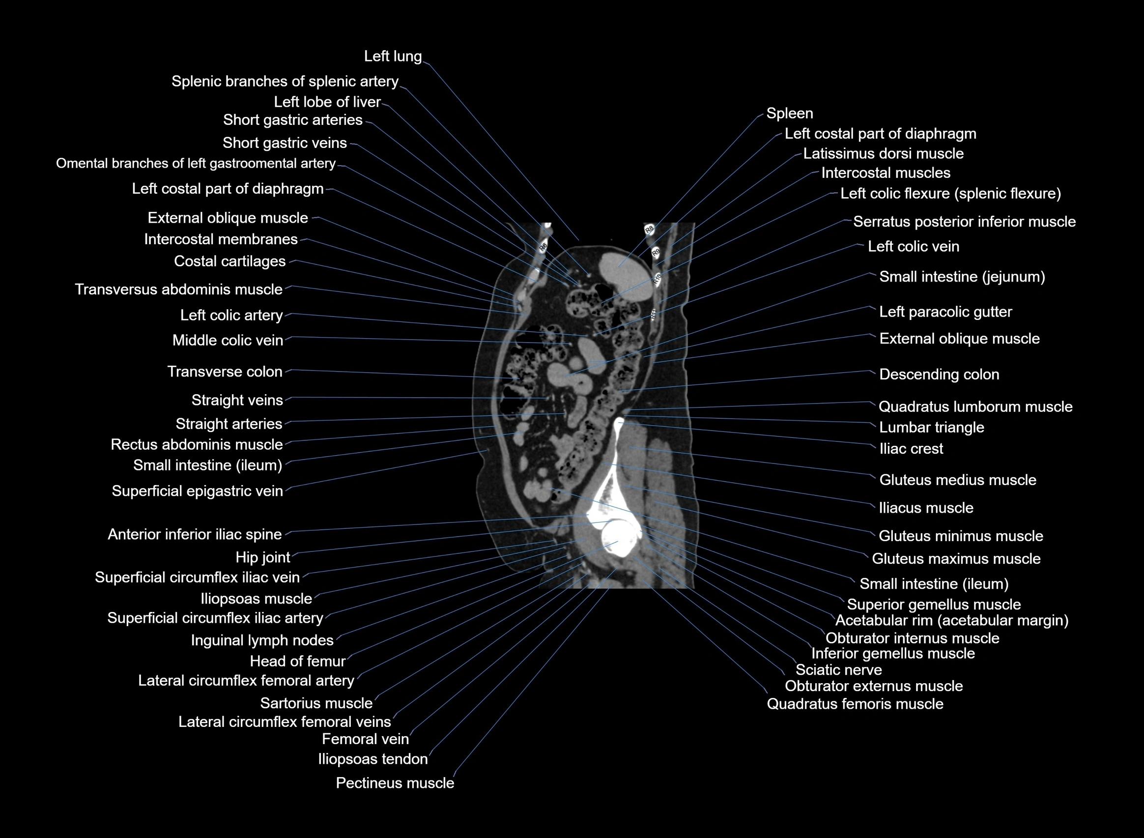 CT Abdomen sagittal cross sectional anatomy labelled radiology image -00027.webp